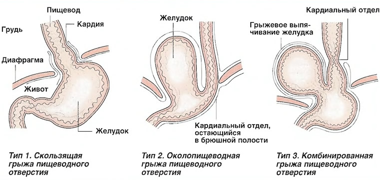 Лечение диафрагмальной грыжи - показания и противопоказания, цены в клинике СОЮЗ.