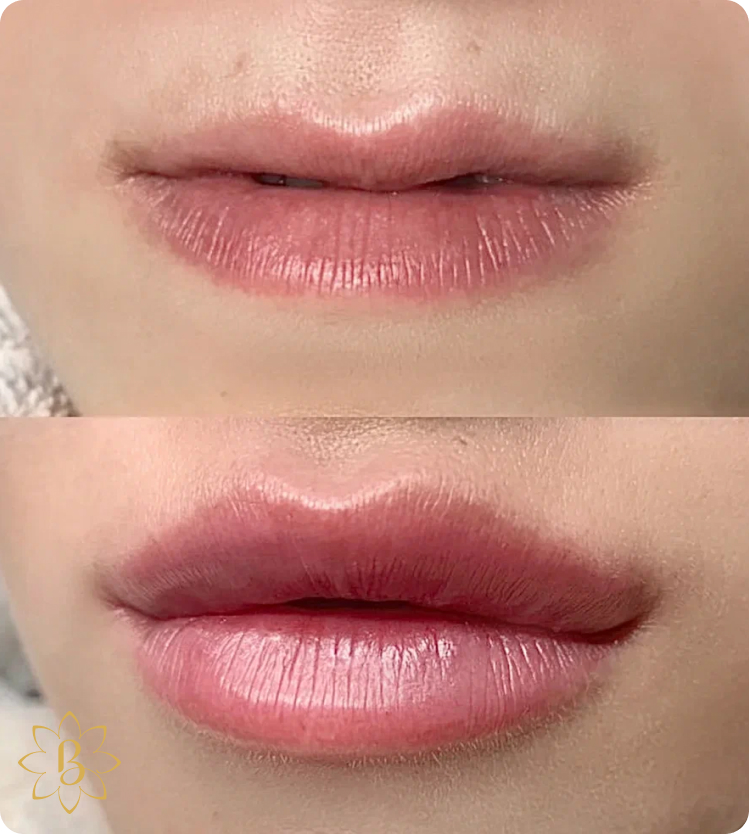 Александритовая лазерная эпиляция СПб