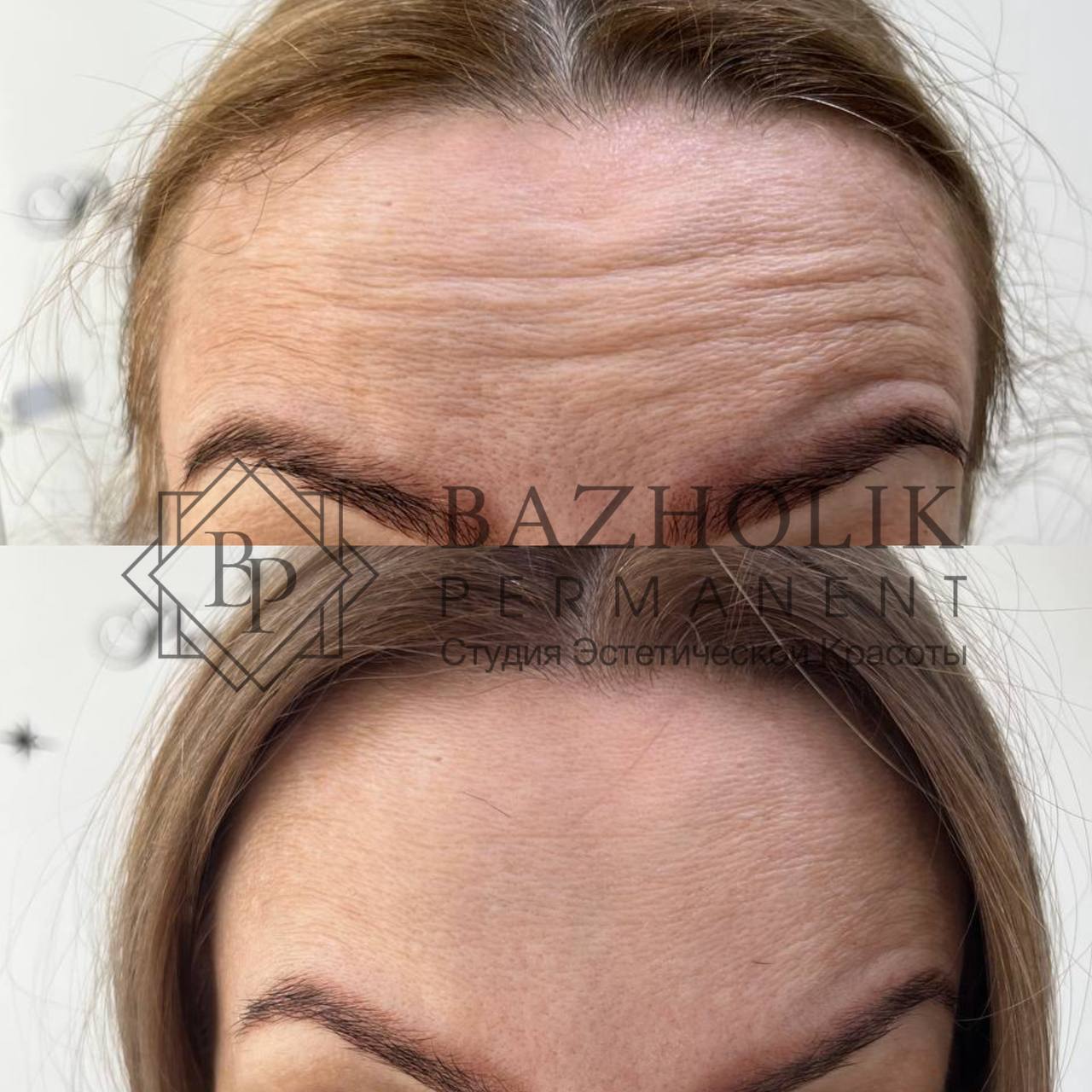 морщины на лбу, межбровка, уколы ботокс