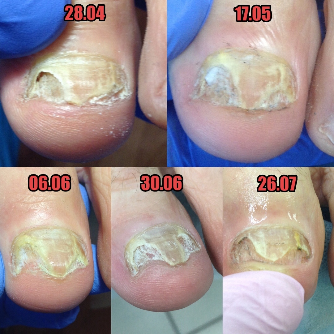 Грибок ногтей