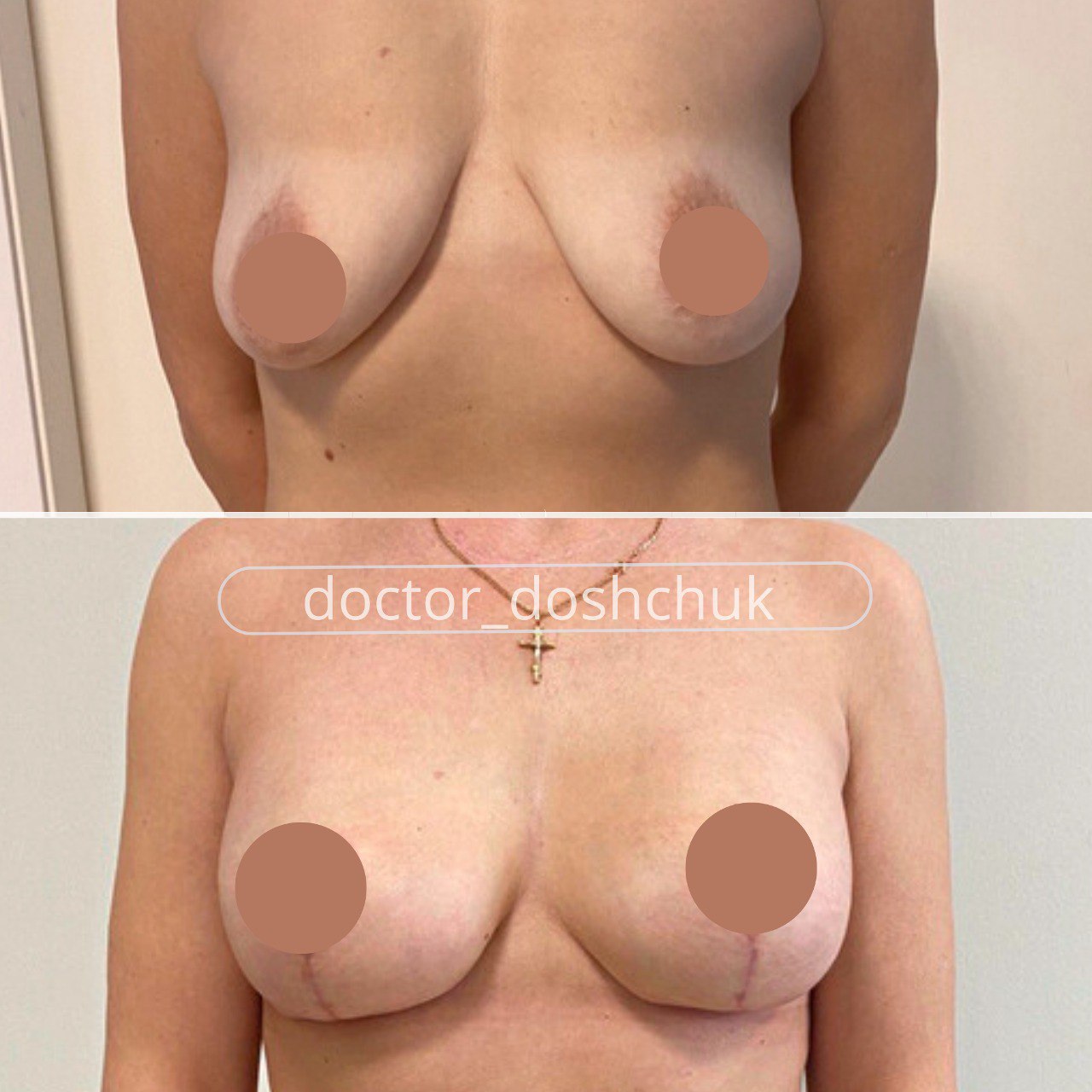 удаление и восстановление груди в одну операцию фото 23