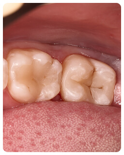Лечение зубов в стоматологии Дент-Арт