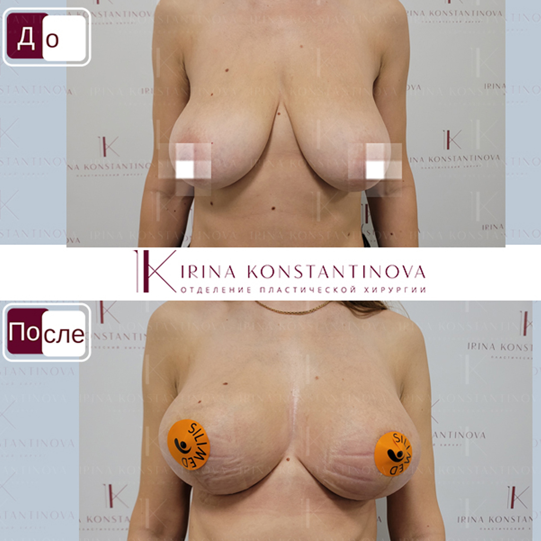 упражнение для подтяжки груди для женщин фото 96