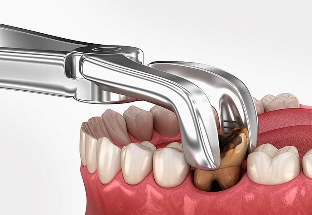 Хирургические решения: понимание процесса удаления зубов и послеоперационного ухода