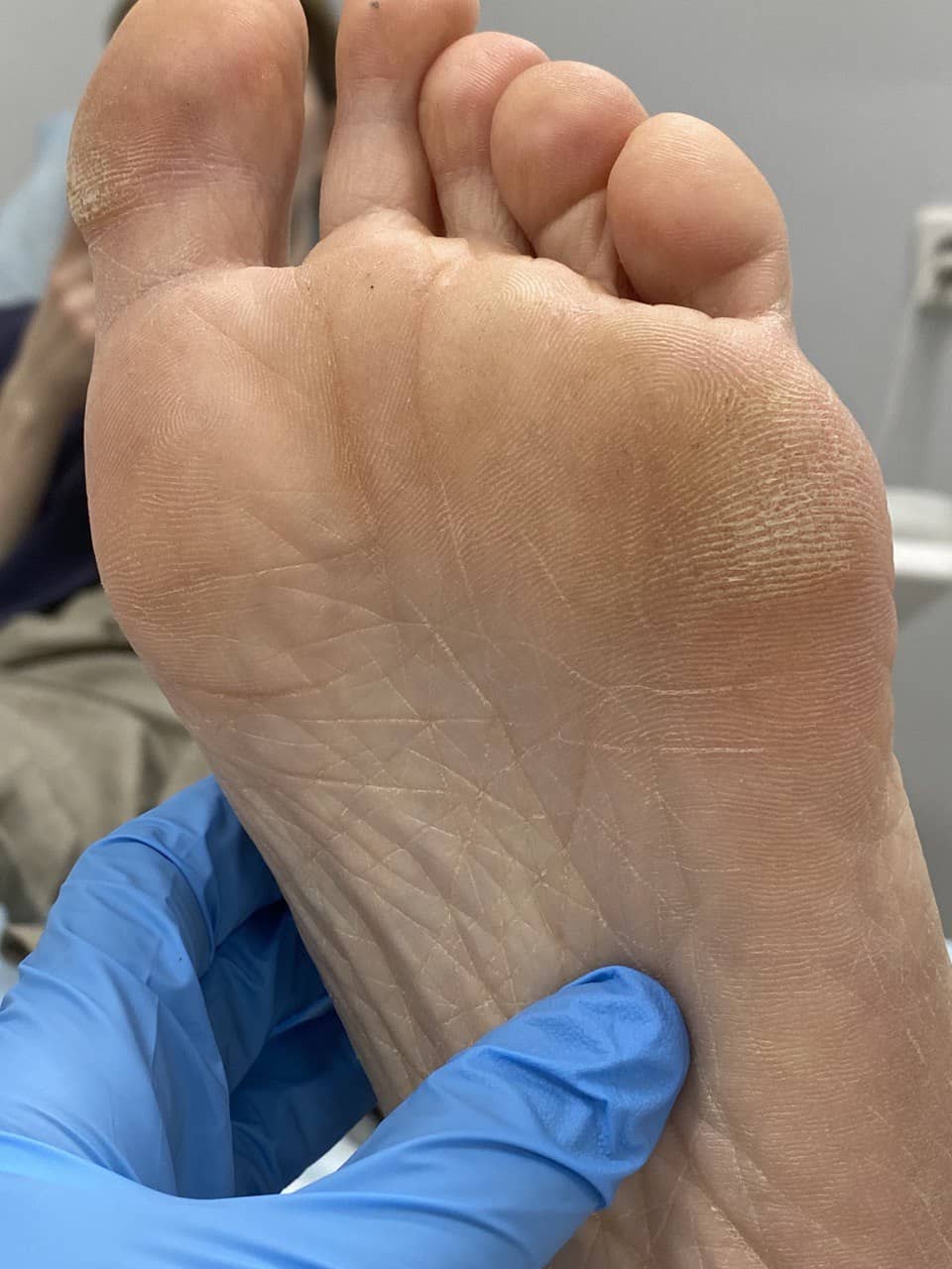 Натоптыш на стопе ноги