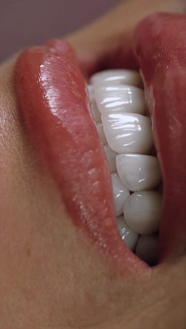 Керамические виниры E-max в Краснодаре – цены на установку