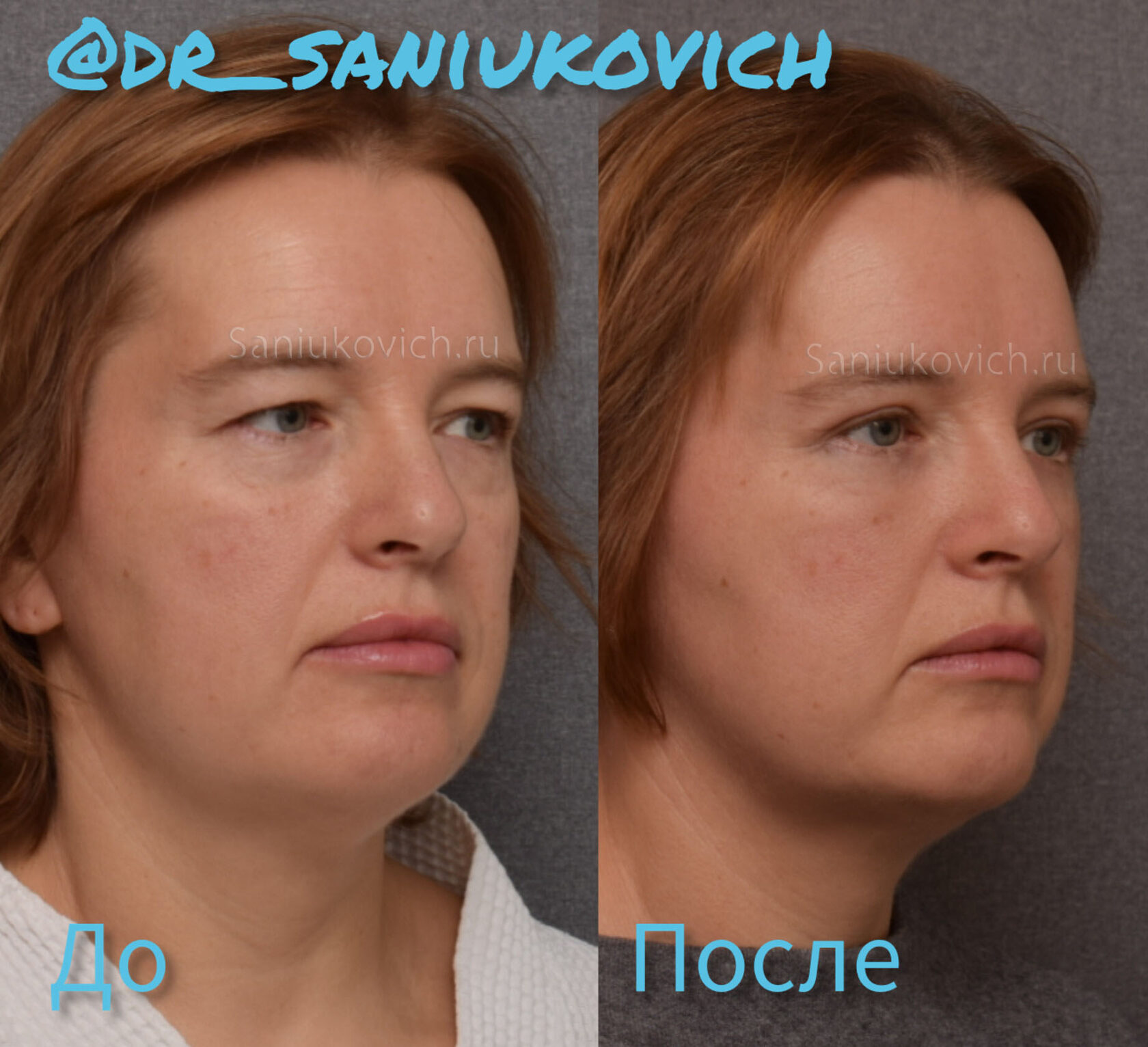 result of circular blepharoplasty