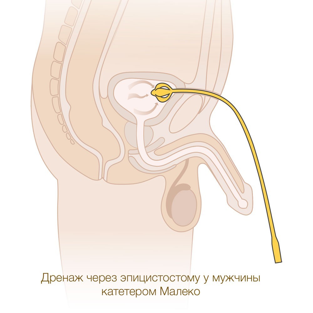 катетер малеко мужской купить