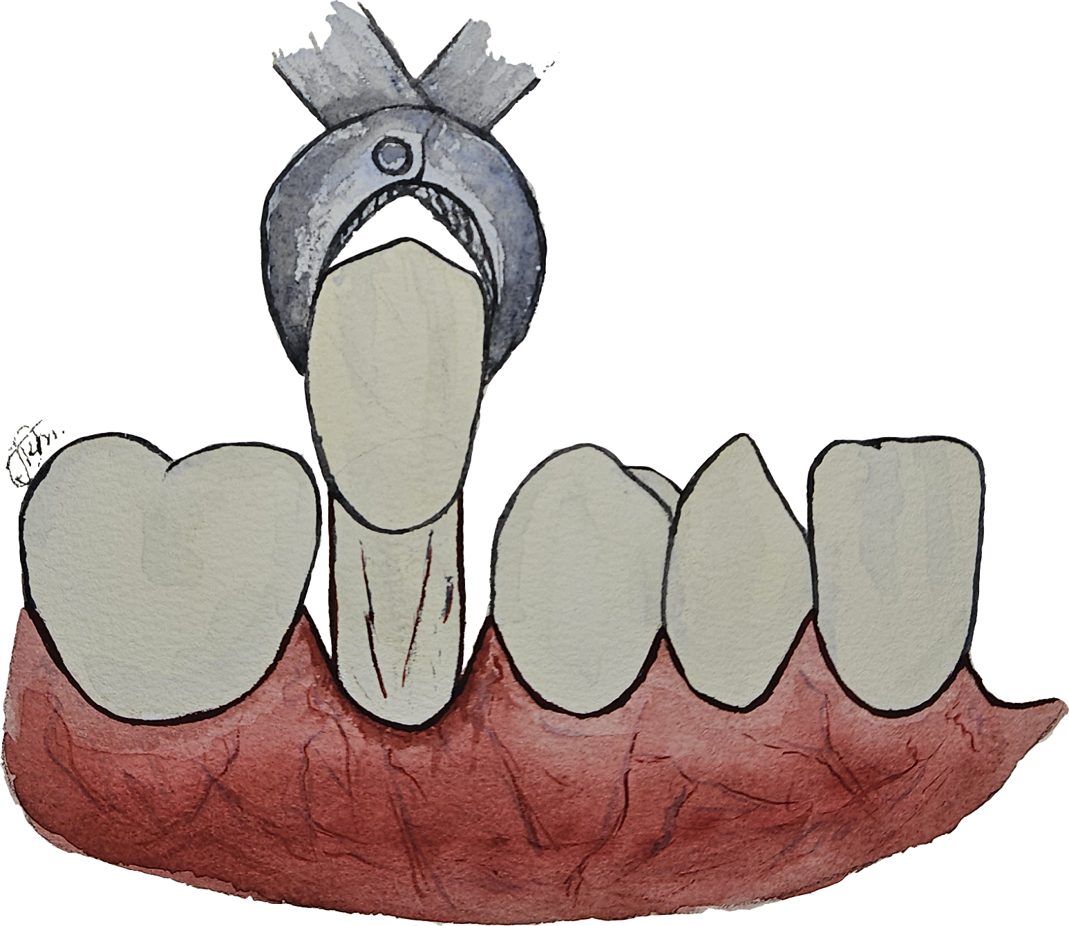 Удаление зуба