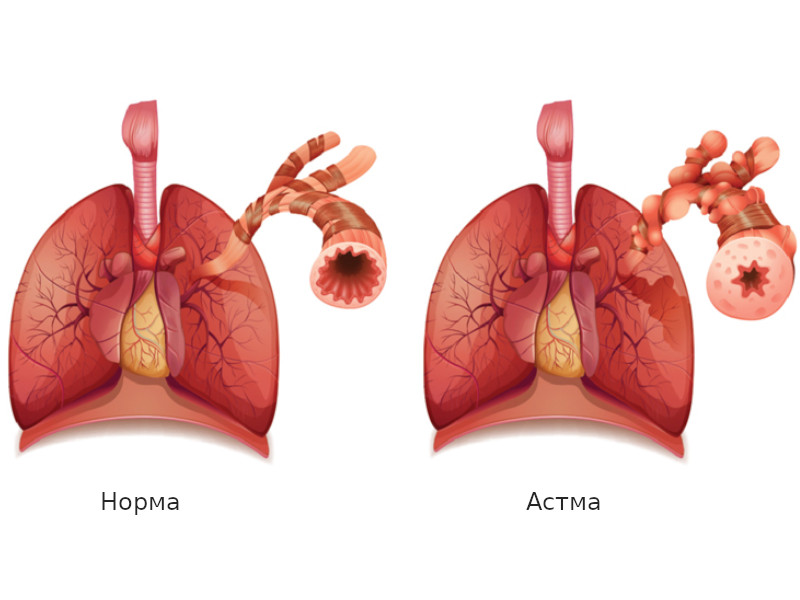 Бронхиальная астма: облегчить симптомы