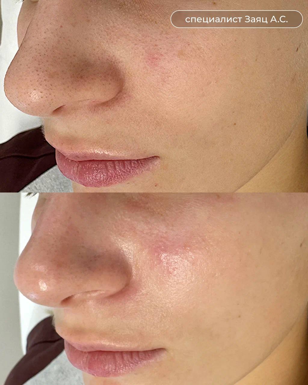 Hydrafacial - До и после