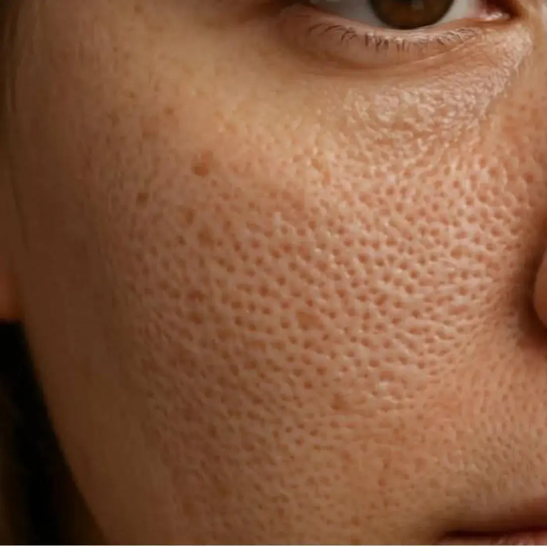 Расширенные поры