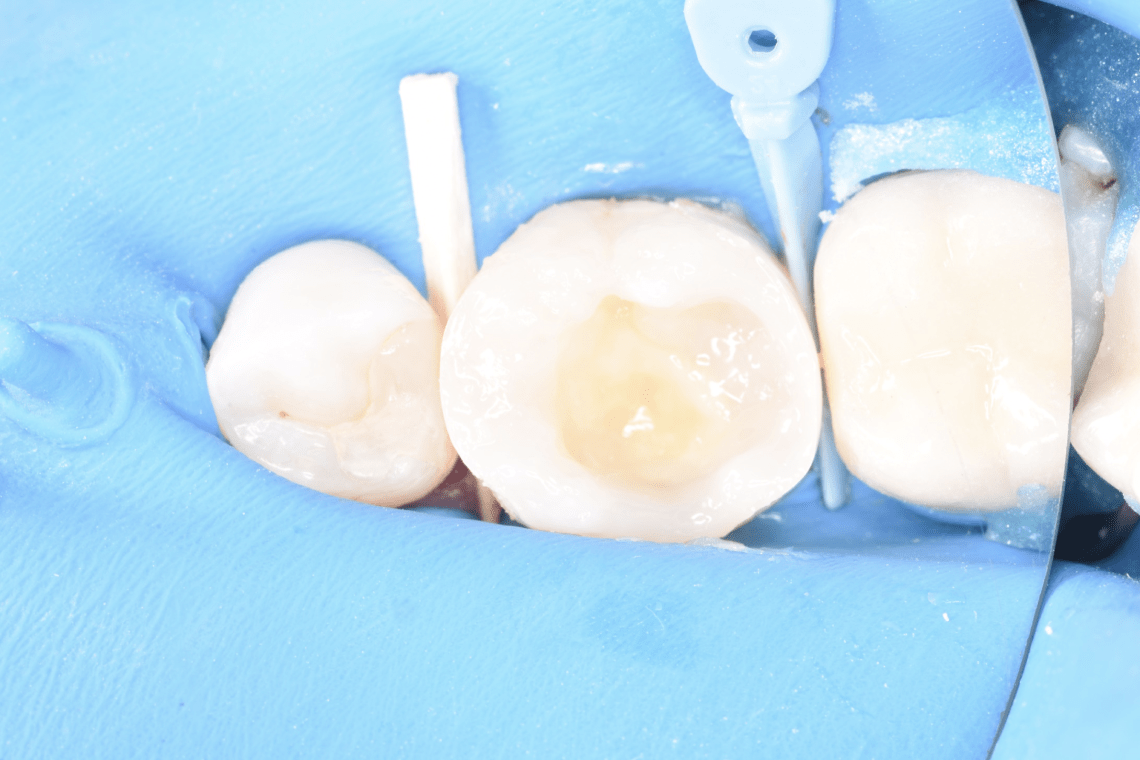 Лечение пульпита зуба - район Раменки