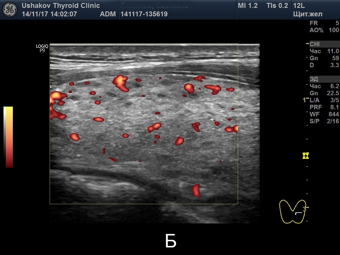 Ультразвуковое исследование диффузного процесса и кровотока щитовидной  железы