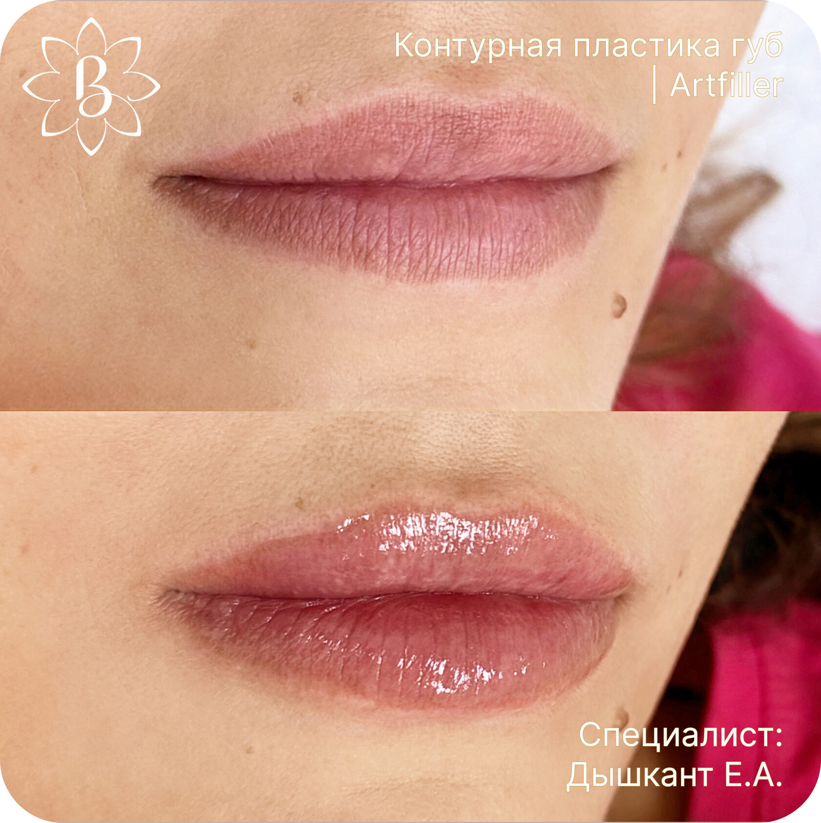 Александритовая лазерная эпиляция