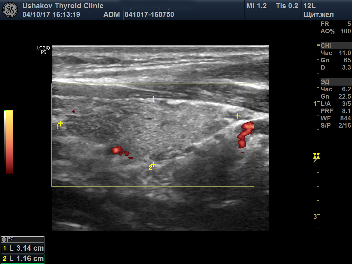 Примеры УЗИ щитовидной железы (с комментариями)