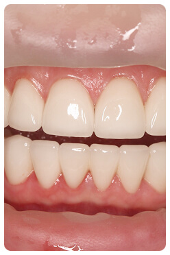 Исплантация зубов в Луганске