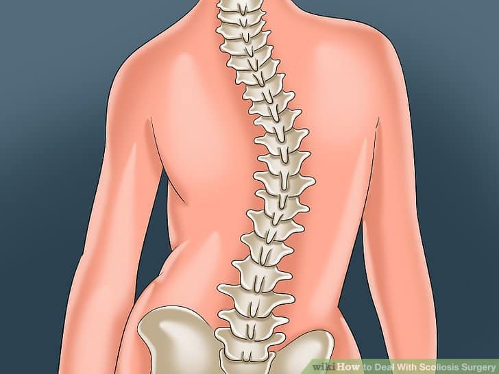 Лечение сколиоза