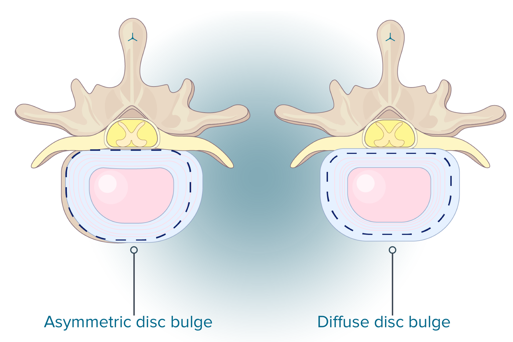 Bulging Disc L4 L5 Guide Treatment Causes And Symptoms