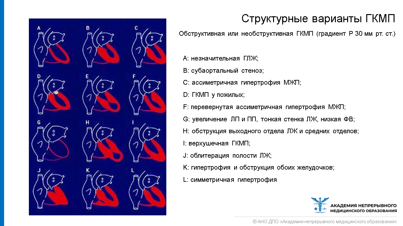 Патологическое спортивное сердце. Основные изменения