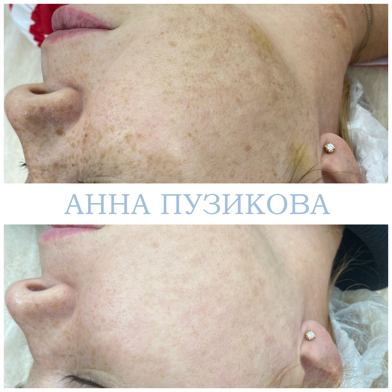 Результат удаления пигментных пятен после курса фототерапии ClearLight IPL — врач-косметолог Пузикова Анна Анатольевна, Санкт-Петербург