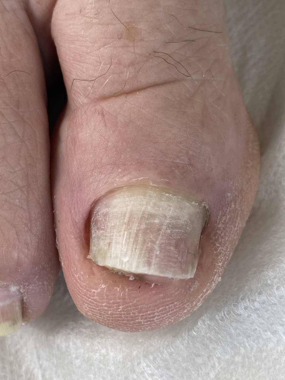 вросший ноготь скобки, скобки +на ногти поставить