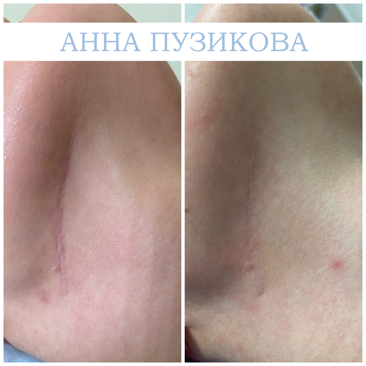 Результат удаления шрама у пациента — косметолог Пузикова Анна Анатольевна, Санкт-Петербург