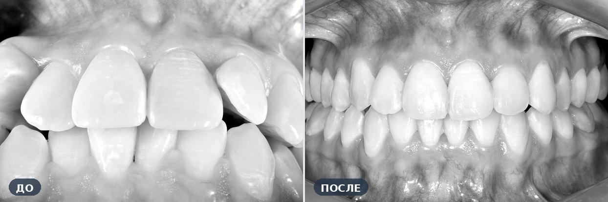 Ортодонтическое лечение: Выраженная скученность — до и после