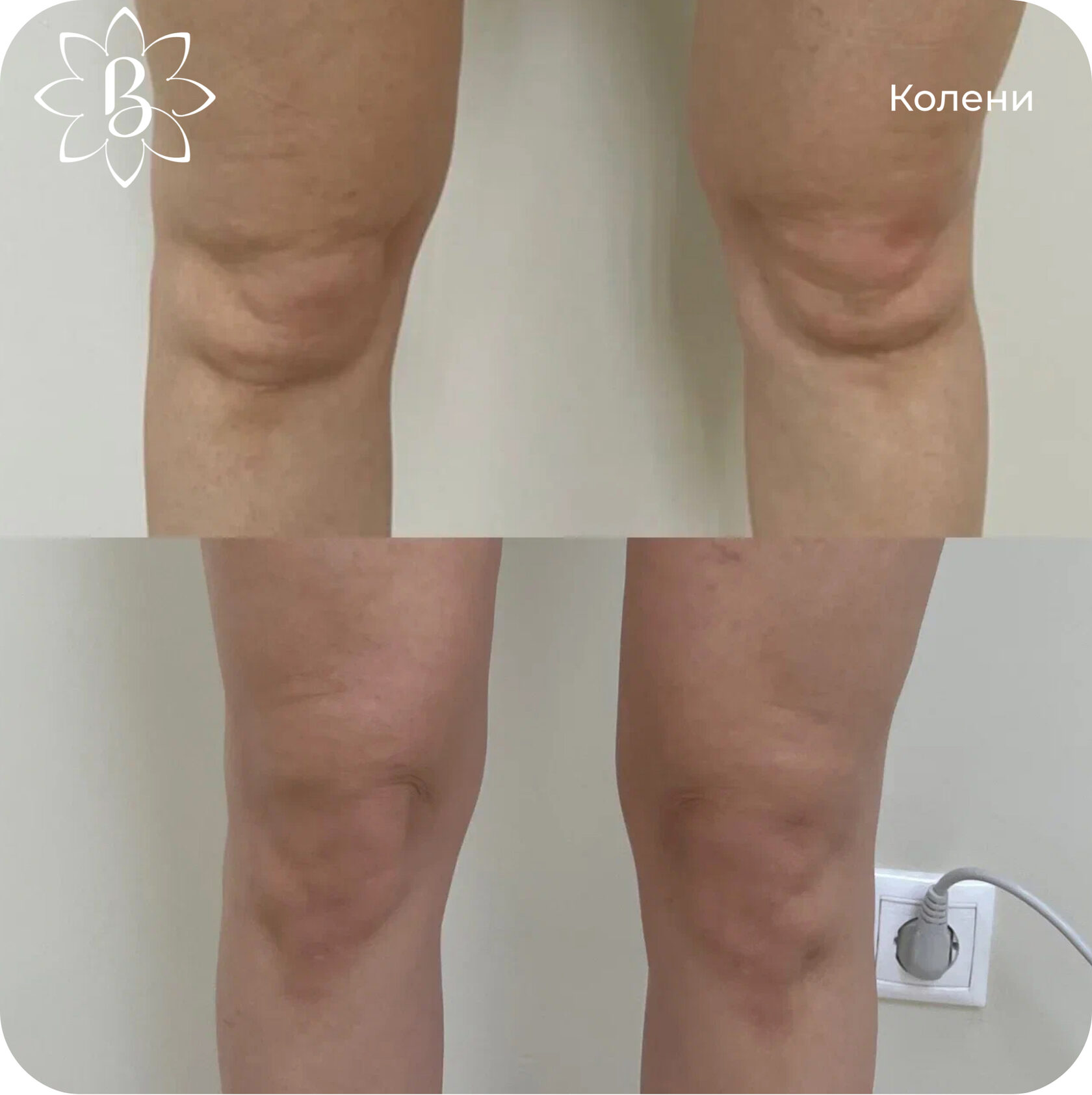 Диодная лазерная эпиляция