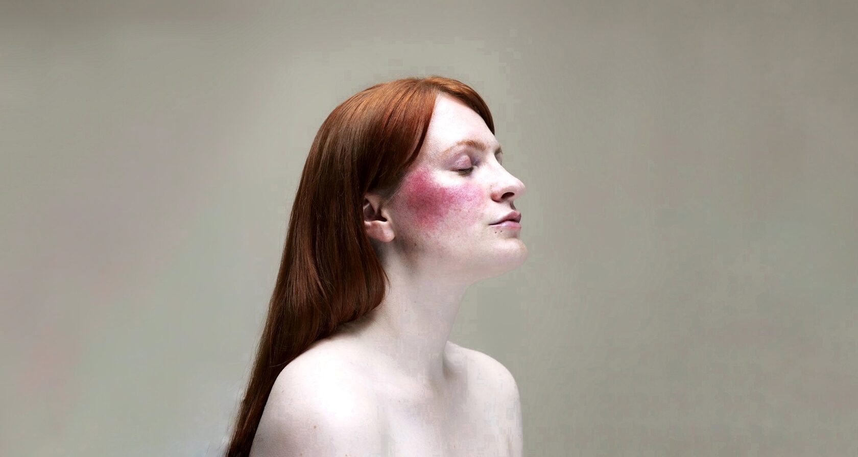 Лечение розацеа