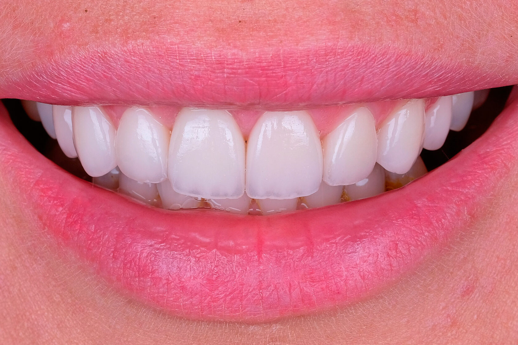 керамические виниры Премиум цвет Блич 3 (Bleach 3)