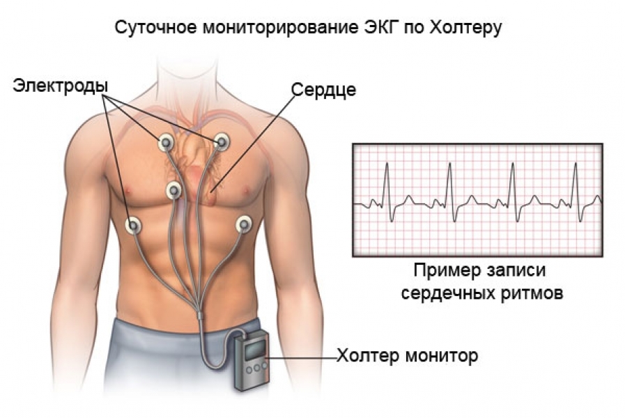 Схема наложения электродов при холтеровском мониторировании 3 канала