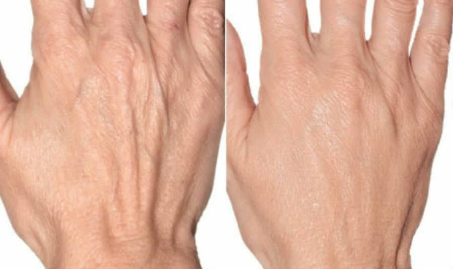 Фото 1. PRP-терапия омоложения рук до и после