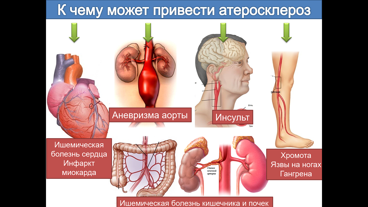 Атеросклероз инсульт