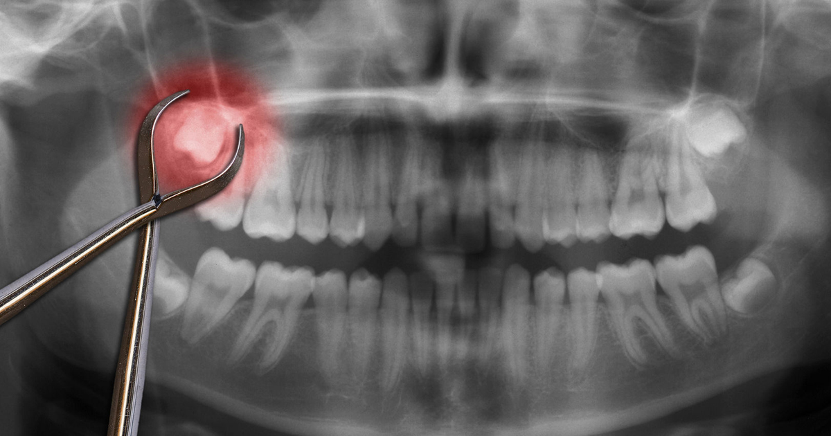 Дистопированный зуб