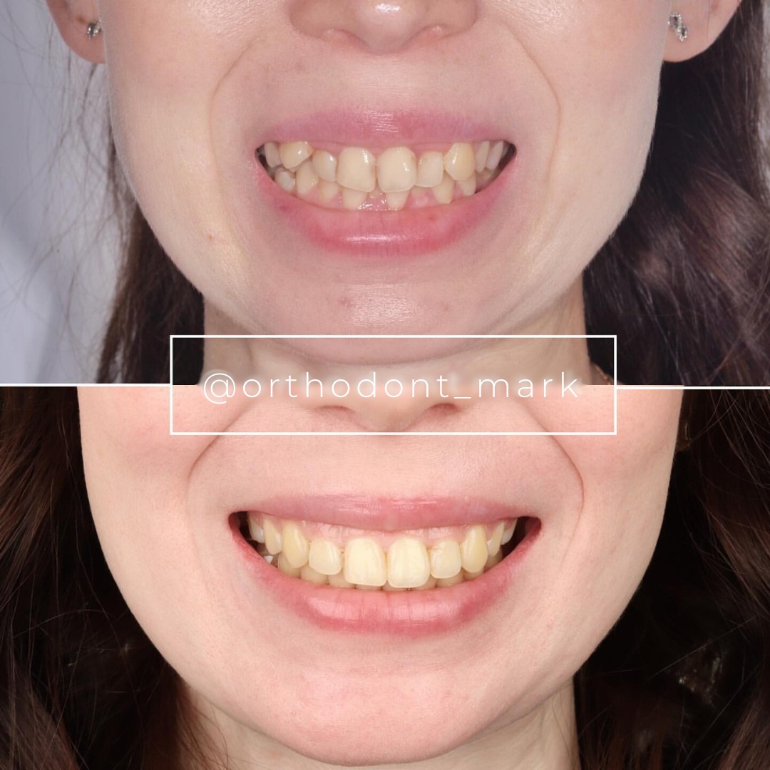 Before and after collage: jaw base narrowing and crossbite corrected to a symmetrical smile — photo 1 of 1