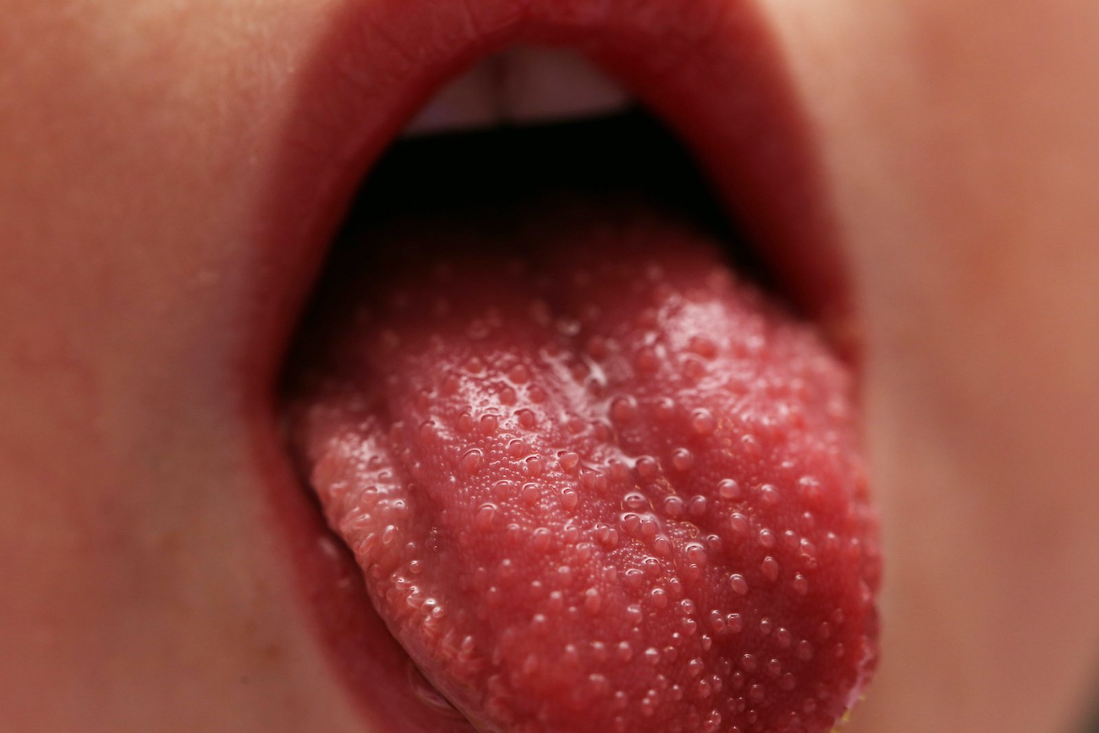 Скарлатина фото языка