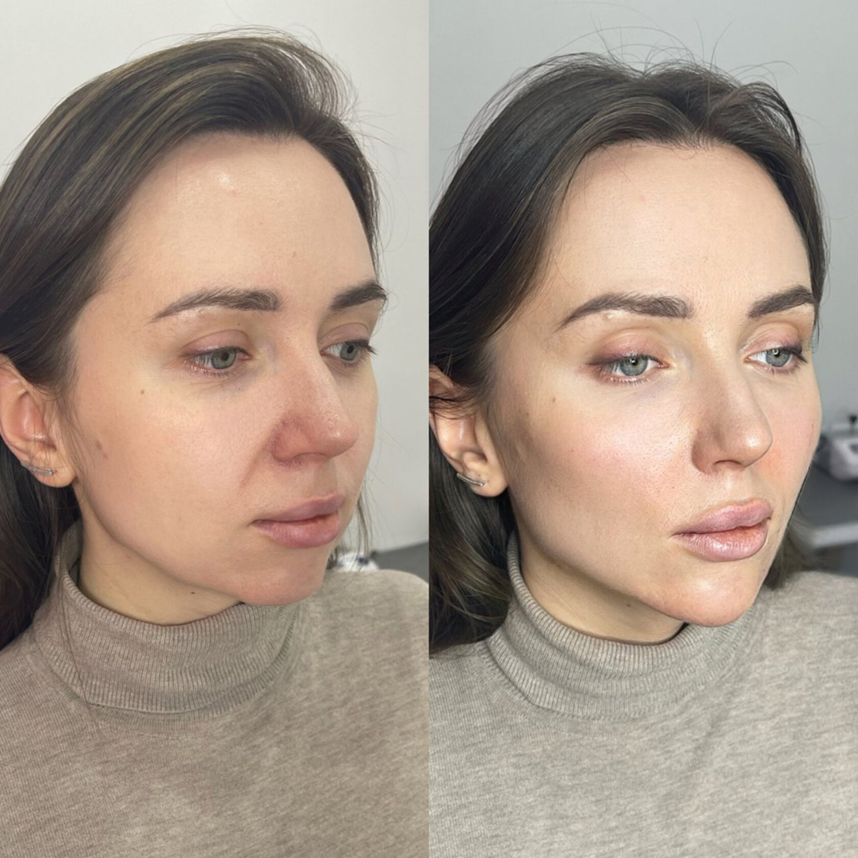 Процедура фул фейс. Ботокс Full face до и после. Ботокс фулл фейс до после. Фулл фейс фото до и после.