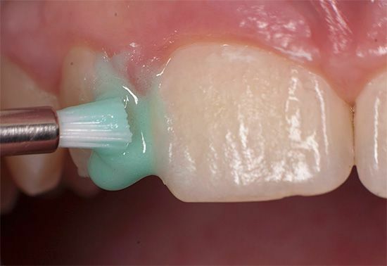 Как восстановить зубную эмаль