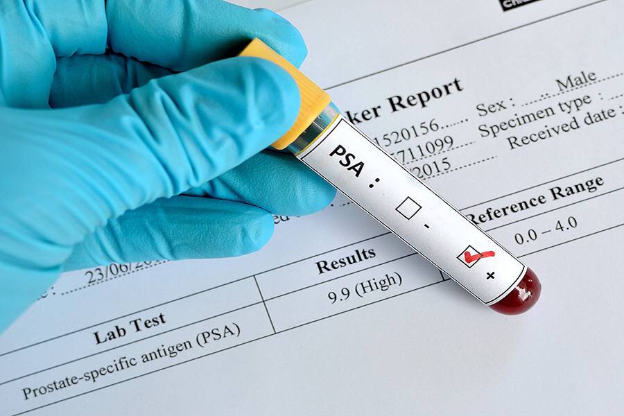 What Age To Stop Psa Testing