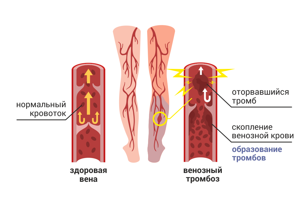 Проходимость глубоких вен. Тромбофлебит и флеботромбоз. Флеботромбоз классификация. Флеботромбоз нижних конечностей.