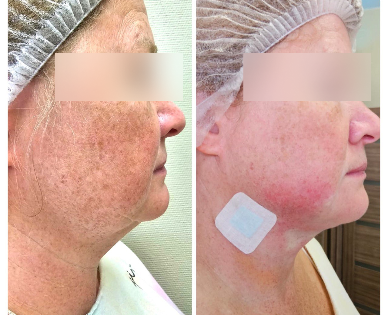 Липоредукция второго подбородка - подтянутый и четкий контур всего за 1 ...