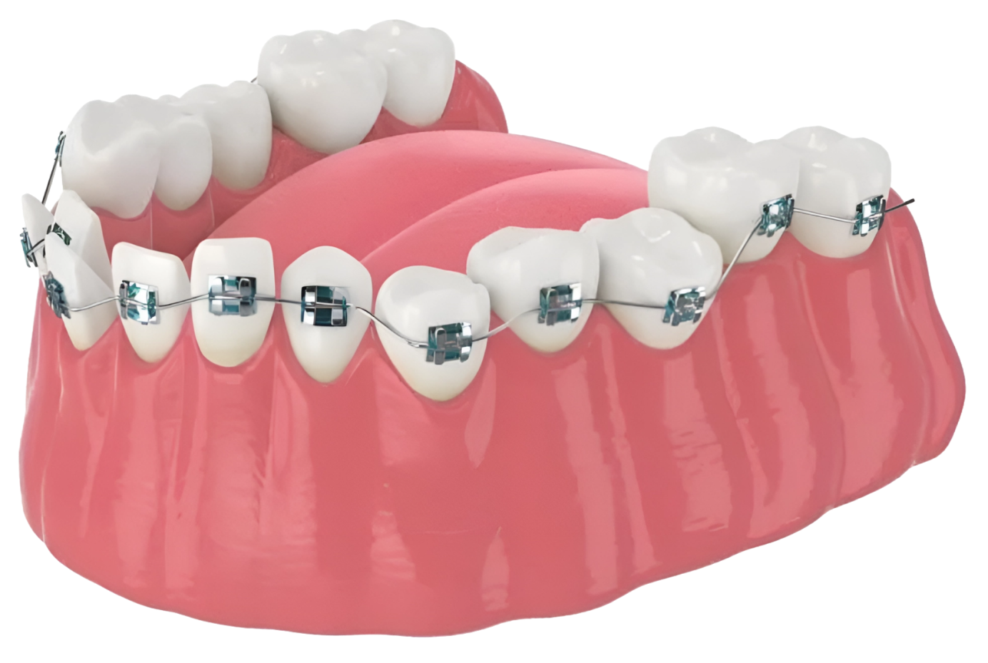 Установка имплантов в Дербенте. Имплантация при отсутствии одного зуба.