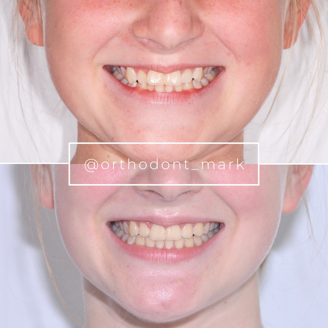 Crowding and Deep Bite Correction With Six-Year Stability