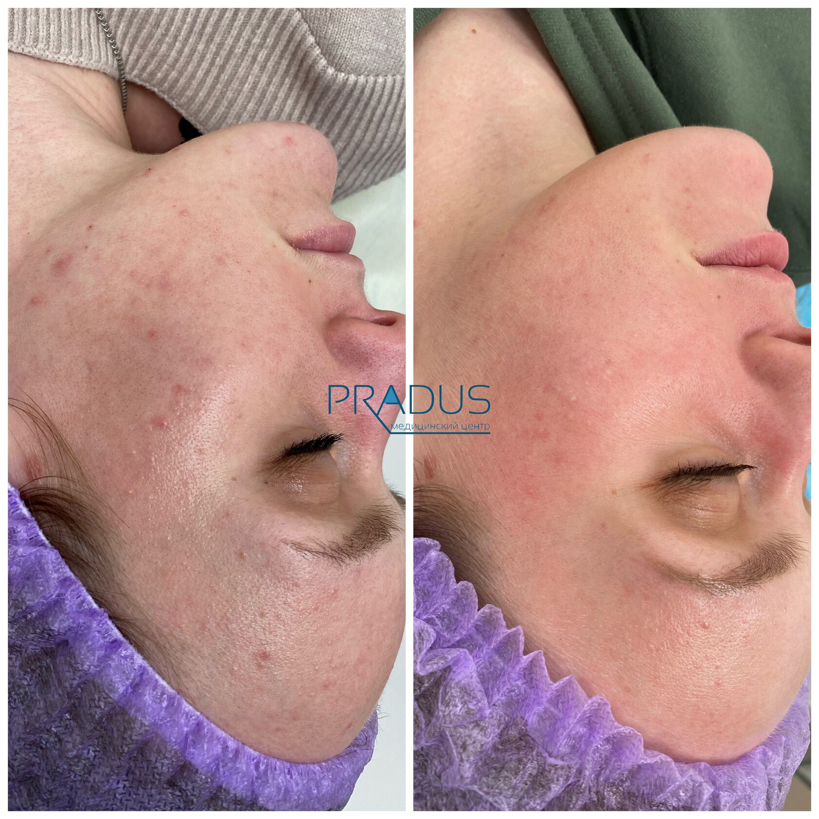 Лечение акне у женщины в клинике PradusCOSMO, СПб. До и после процедуры