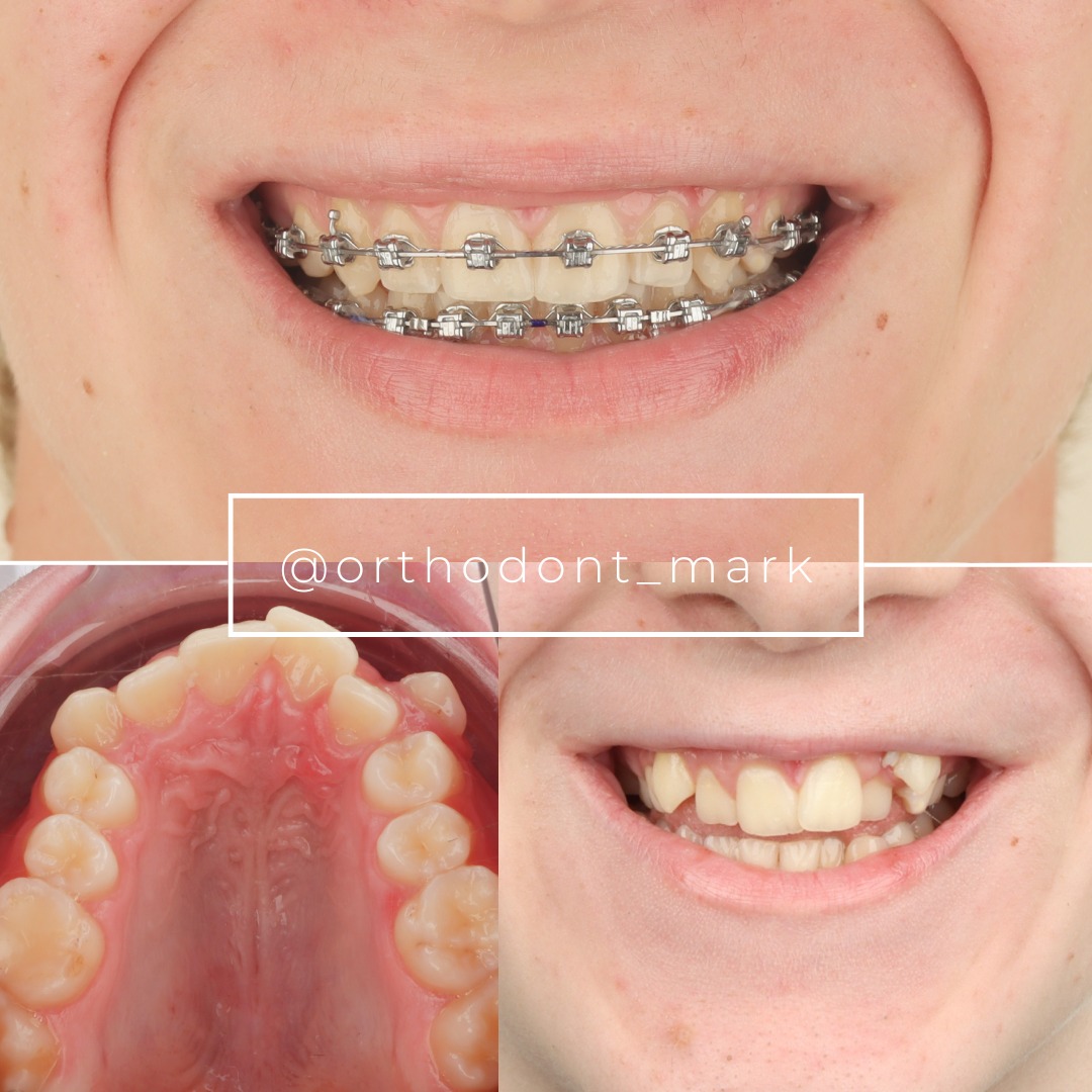 Before and after illustration of crowded teeth relieved through orthodontic space creation