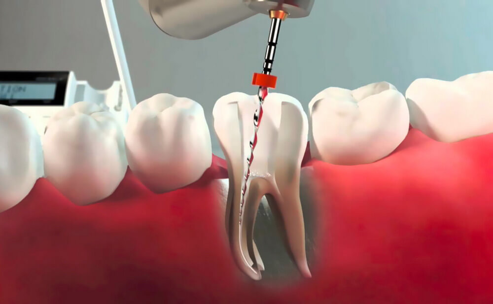 Удаление нерва и пломбирование каналов зуба