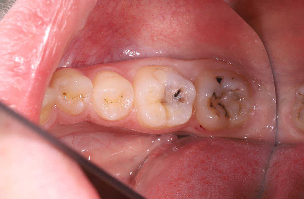 Избавление от кариеса зубов нижней челюсти с применением композита Гармонайз А3