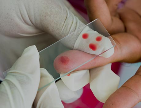 Как проводят анализ крови при онкологии