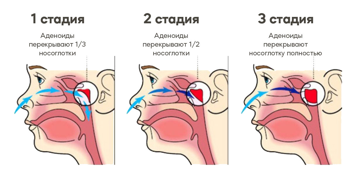 Лечение аденоидов